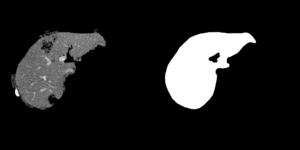 Liver Cancer Segmentation in DICOM Images